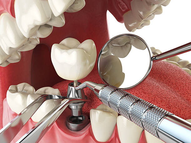 Best Cracked Tooth Emergency Dentist  in Peculiar, MO